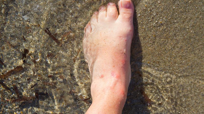 Sivrisinekler artık sizi ısıramayacak! Çok özel bir yöntem bulundu