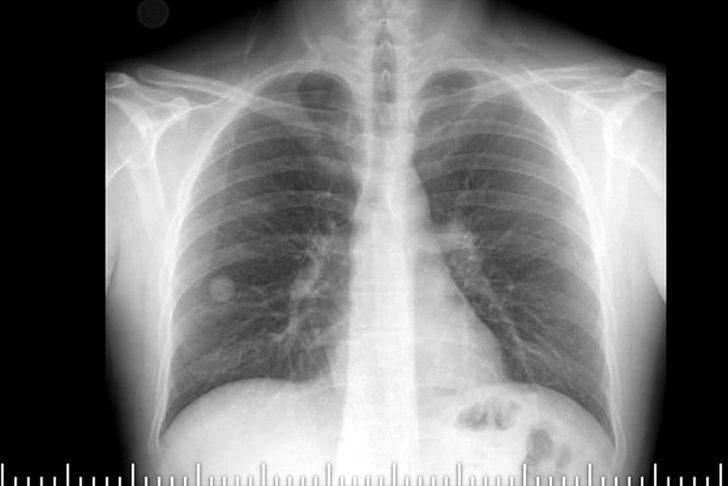 Kanserden şüpheleniyorlardı, akciğerinden böcek çıktı! G2