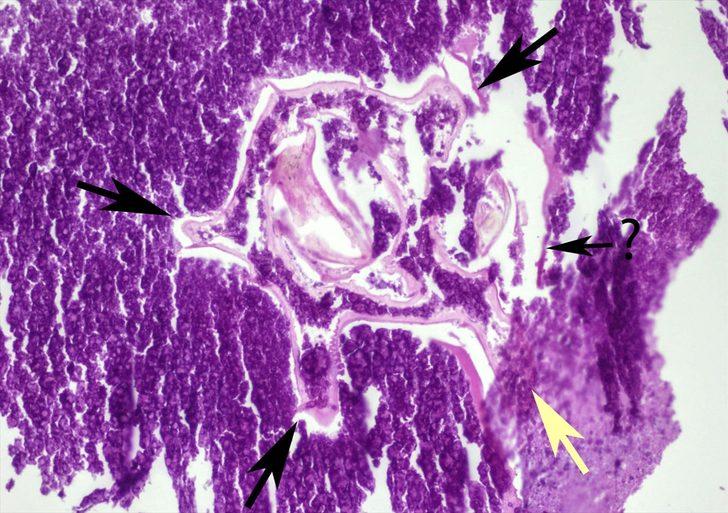 Kanserden şüpheleniyorlardı, akciğerinden böcek çıktı! G4