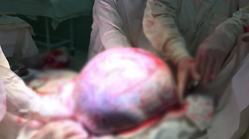 Karnından plaj topu büyüklüğünde tümör çıkarıldı!