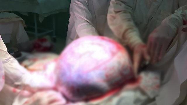 Karnından plaj topu büyüklüğünde tümör çıkarıldı!