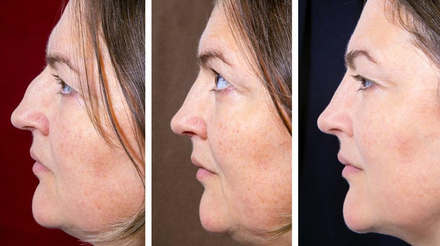 Gıdı sarkmasına dikkat 