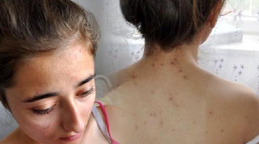 Çanakkale'de Hilal Yavaş arıların saldırısına uğradı