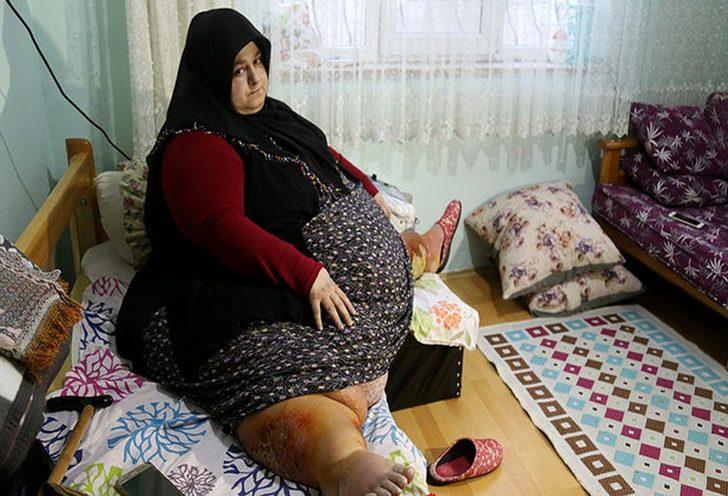 Sakarya’da yaşayan ve 250 kilo olan Sevim Bal obezite ameliyatı ile 95 kiloya düştü
