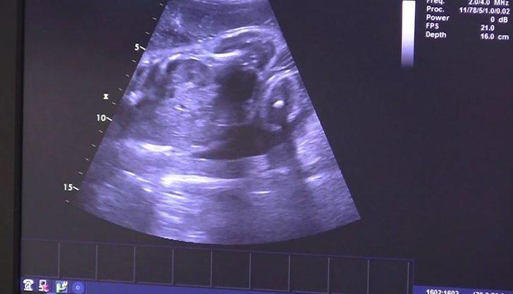 Annesinin beyin ölümünün gerçekleşmesinden 3,5 ay sonra doğdu G3