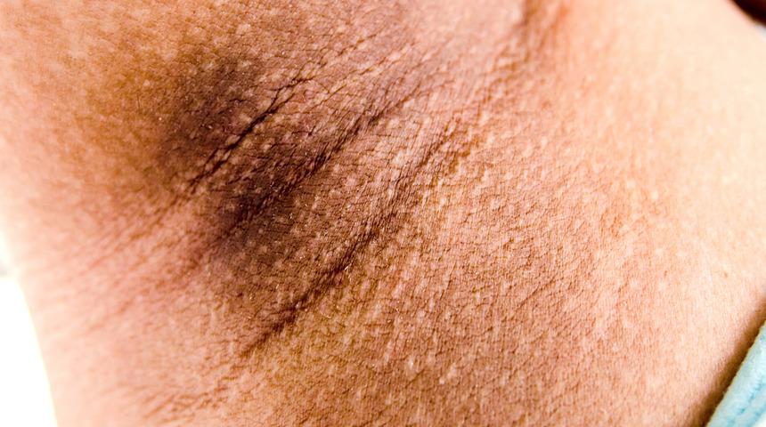 Hepimizin sorunu! Koltuk altı kararmasının önüne evdeki çözüm yollarını kullarak geçin 