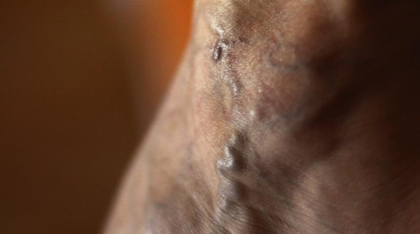 Tedavi edilmeyen variste ölüm riski