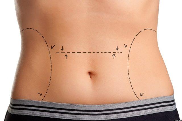 Liposuction zayıflama yöntemi değildir