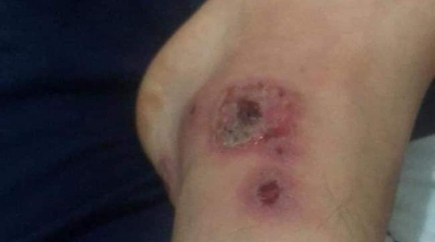 Sivrisineklerin ısırdığı vatandaş, yaraları sebebiyle evinden &ccedil;ıkamıyor