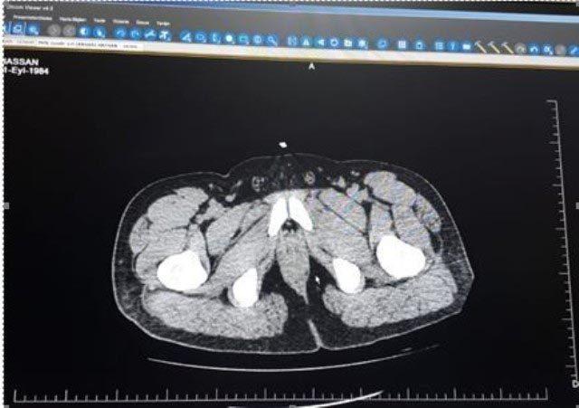 İranlı kurye, midesinde 250 gram eroinle yakalandı