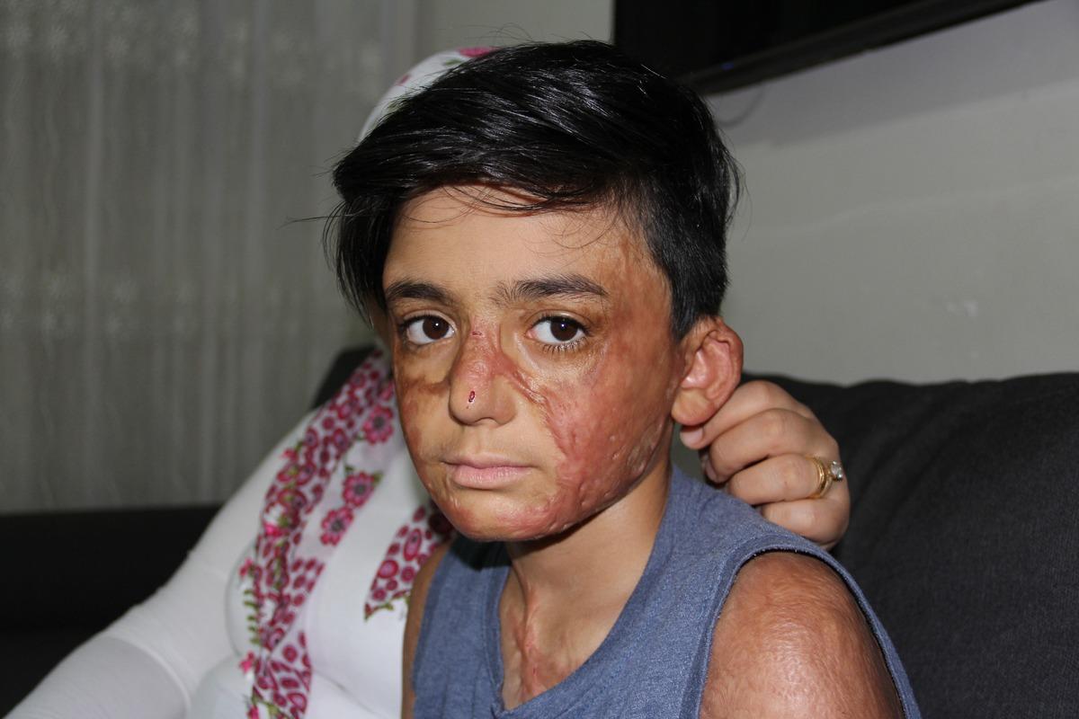 Doktorlar 'yaşama şansı y&uuml;zde 1' demişti! Umut&rsquo;un acı &ccedil;ığlığı: Eski derimi istiyorum