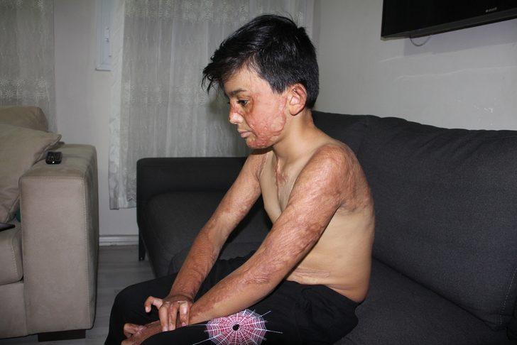 Doktorlar 'yaşama şansı yüzde 1' demişti! Umut’un acı çığlığı: Eski derimi istiyorum G1