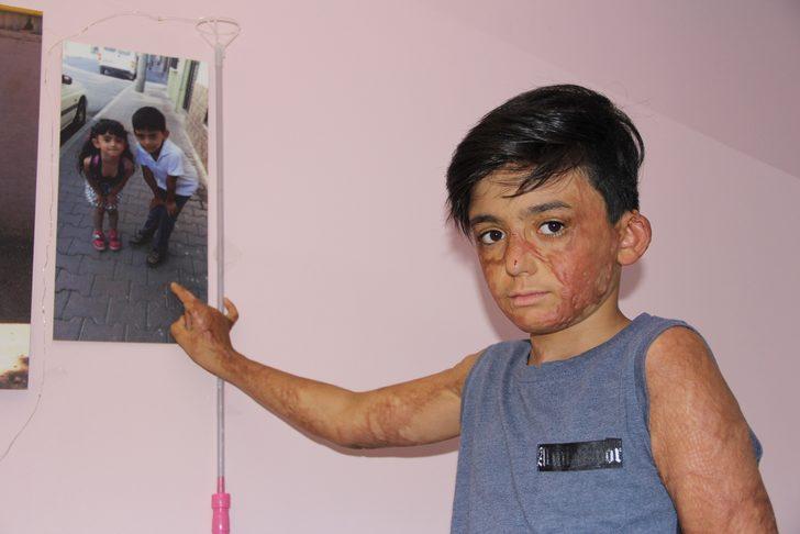 Doktorlar 'yaşama şansı yüzde 1' demişti! Umut’un acı çığlığı: Eski derimi istiyorum G2