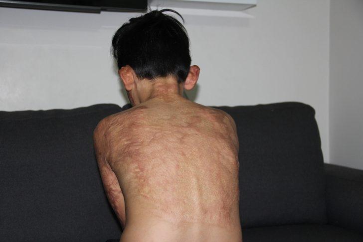 Doktorlar 'yaşama şansı yüzde 1' demişti! Umut’un acı çığlığı: Eski derimi istiyorum G4