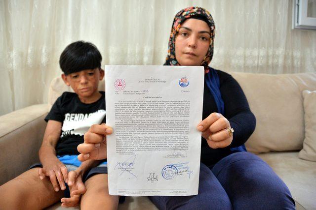 Yangında y&uuml;z&uuml; ve v&uuml;cudu yanan Umut i&ccedil;in kampanya 2