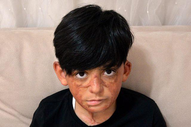 Yangında y&uuml;z&uuml; ve v&uuml;cudu yanan Umut i&ccedil;in kampanya 4