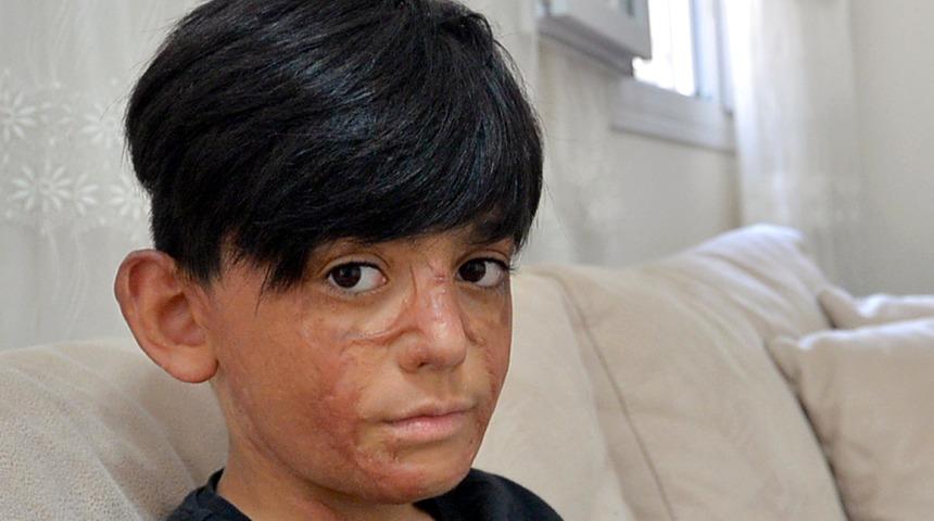 Yangında y&uuml;z&uuml; ve v&uuml;cudu yanan Umut i&ccedil;in kampanya