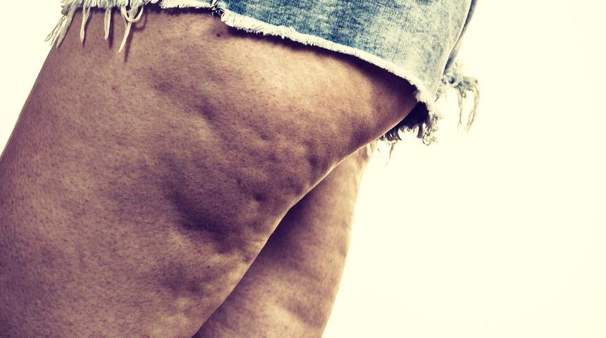 Selülit tedavisinde G5 masajı neden önemli?