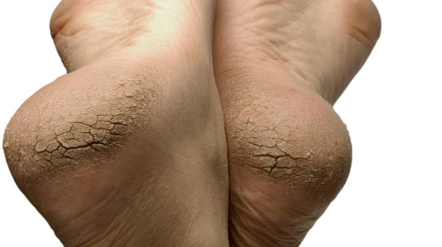 Bu kullanışlı maske ile bir daha asla topuk çatlağınız olmayacak