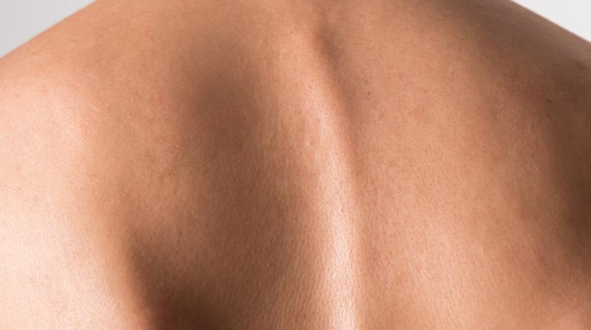 Skolyoz hamilelikte artıyor