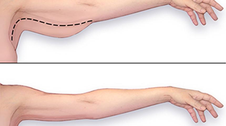 Muhallebi kıvamındaki kollara veda: 3 basit hareketle sarkık kollarınızdan kurtulun