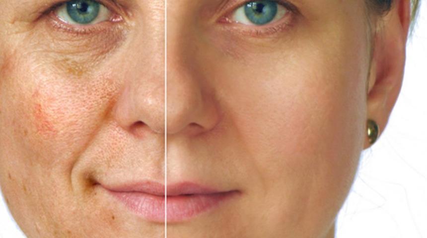 Bu ev yapımı maskeler sayesinde cildinizdeki g&uuml;neş lekeleriyle vedalaşabilirsiniz! 