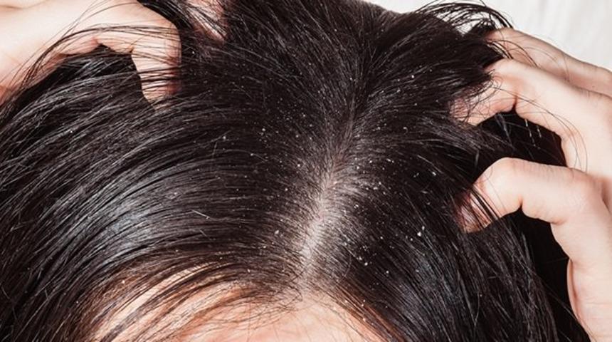 Pahalı Şampuanlara Başvurmadan Evde Kepekleri Yok Edebileceğiniz 6 Doğal Y&ouml;ntem