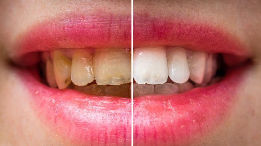 Çok sık tercih ediliyor! Diş beyazlatmada macunlara, gargaralara güvenmeyin