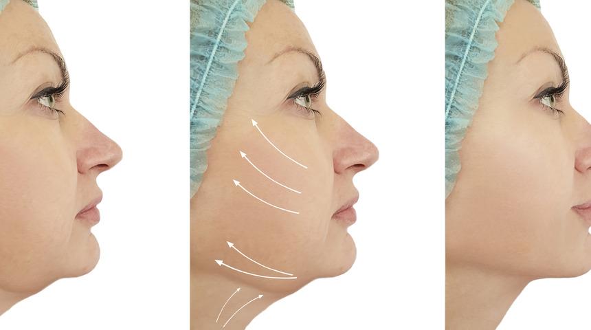 Yüz estetiği ile 10 yaş gençleşin