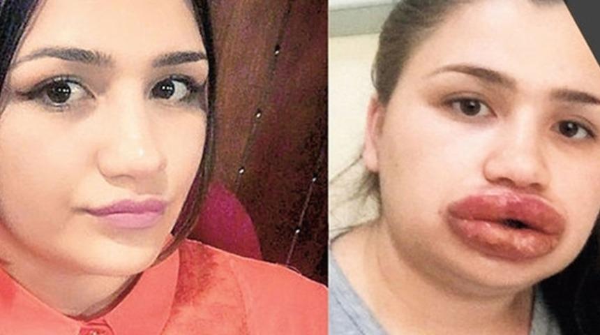 Hemşire Kadın Kuaförde Estetik Yaptırdı: Dudaklarını Kaybedebilir!