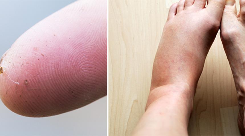 Arı sokmasına ne iyi gelir? Arı sokması tedavisinde evde uygulanabilecek basit ve doğal yöntemler nelerdir?