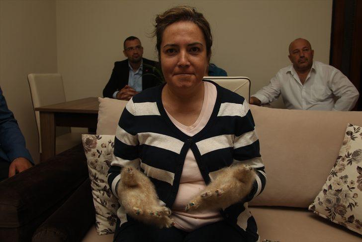 'Raynaud fenomeni' hastalığına yakalandı! G1