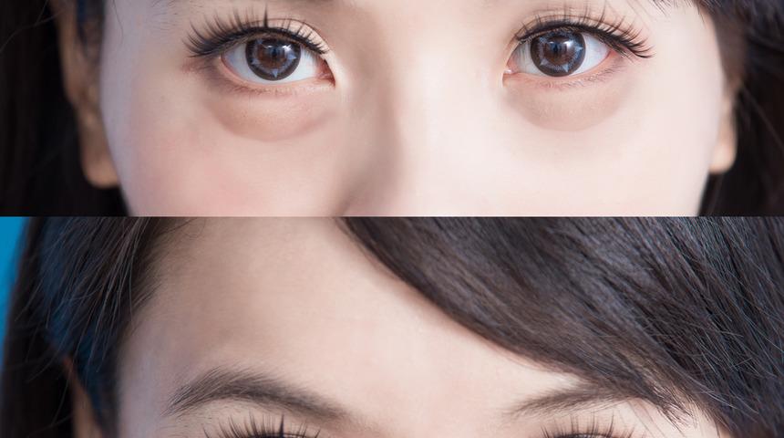 Merdiven altına dikkat! Göz torbası deyip geçmeyin 