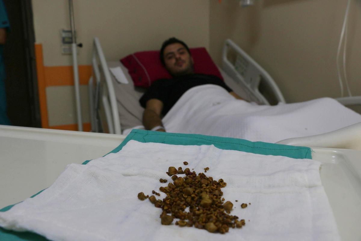 Karın ağrısı şikayetiyle gitti, safra kesesinden 400 taş &ccedil;ıkarıldı