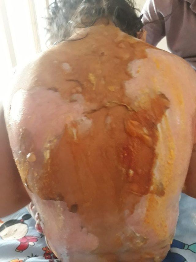 Vücudu yanan kızın tedavisinde ihmal iddiası 3