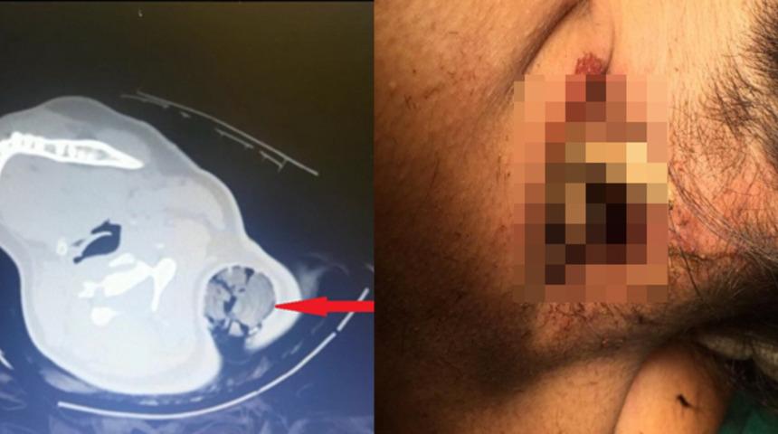 Akılalmaz olay! 30 santim uzunluğunda: Boynuna saplandı