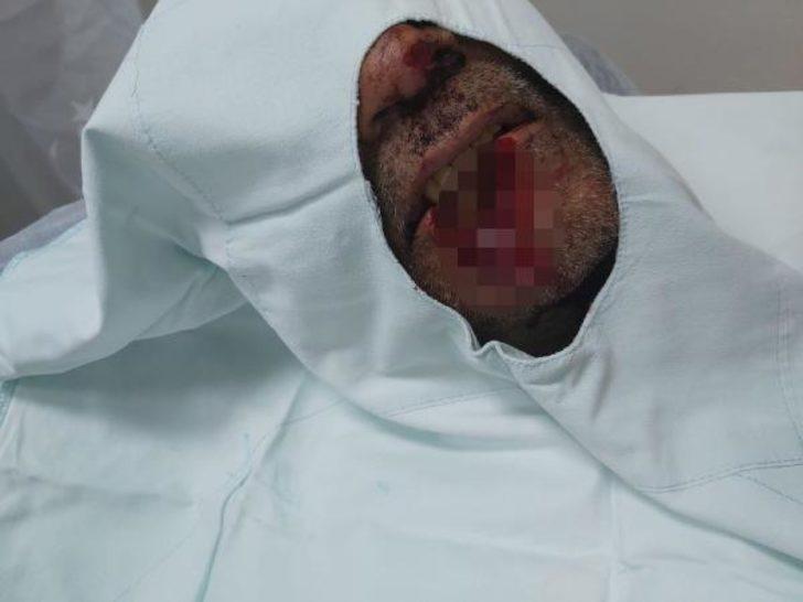 Isırarak kayınpederinin dudağını koparmıştı! 'Hannibal damat' tutuklandı G1