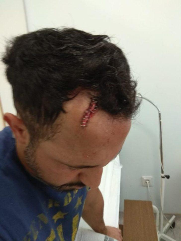 Isırarak kayınpederinin dudağını koparmıştı! 'Hannibal damat' tutuklandı G5