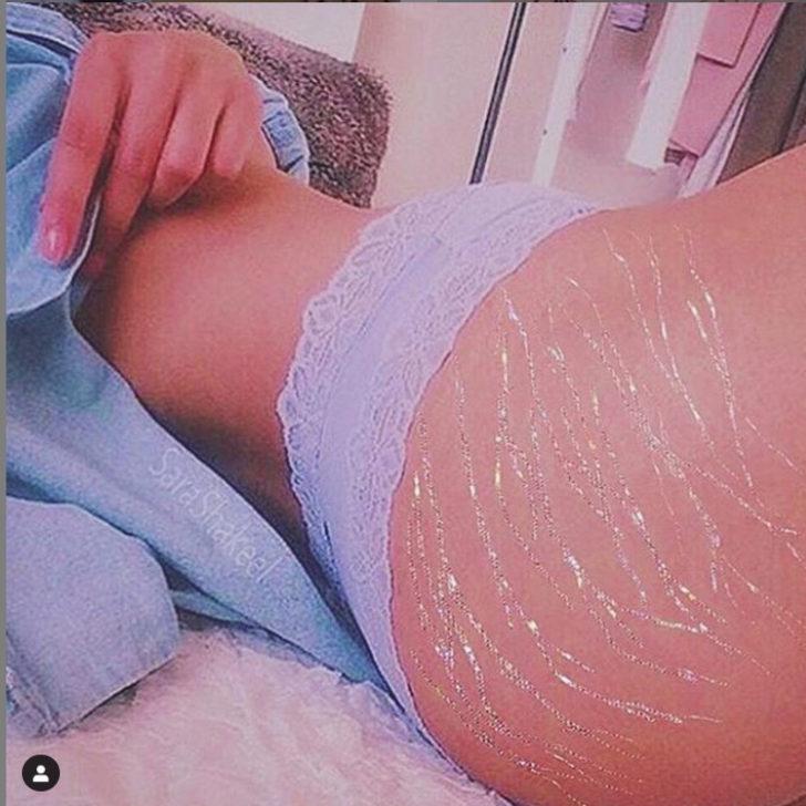 Güzellik standartlarına meydan okudular! Çatlak izlerini böyle ortaya çıkardılar  G4