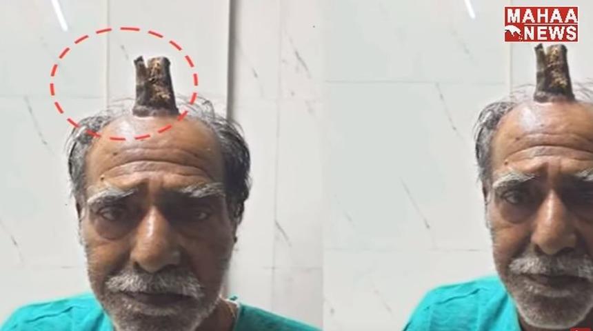 Kafasında 10 santimetrelik 'şeytan boynuzu' çıktı!