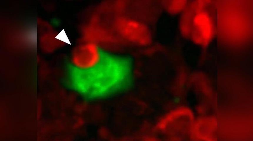 Kanser hücrelerinin ‘yamyamlık’ yaparak hayatta kaldıkları keşfedildi
