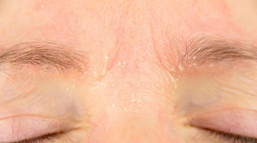 Kışın cilt kuruluğuna karşı 12 &ouml;neri! Kış aylarında cildinize kese yapıyorsanız... 