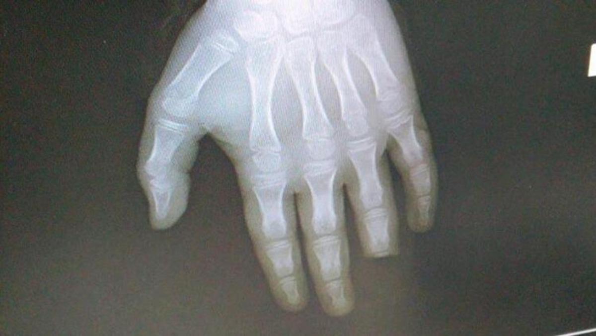 Korkun&ccedil; olay! Denize girdi, parmağının yarısını kaybetti