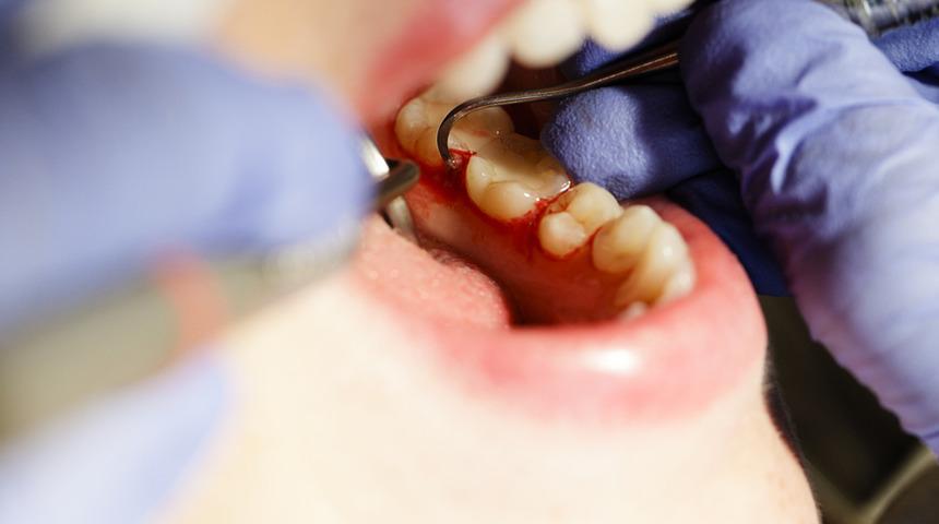 Diş eti hastalığı erken doğum sebebi mi? 