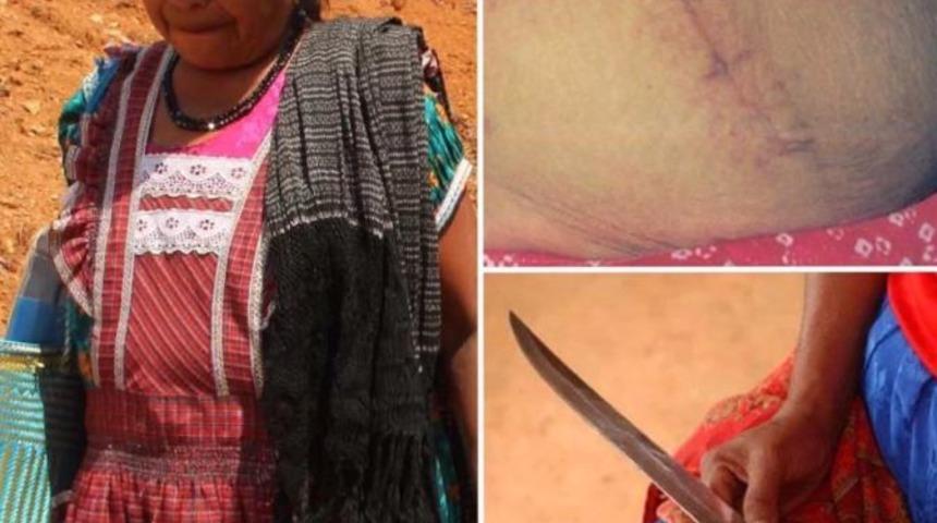 Kendi kendini ameliyat edip hayatta kaldı!