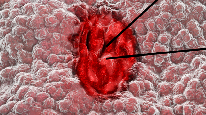 Ülser hastaları nasıl beslenmeli? Ülser olanlar ne yememeli? (Ülser diyeti)
