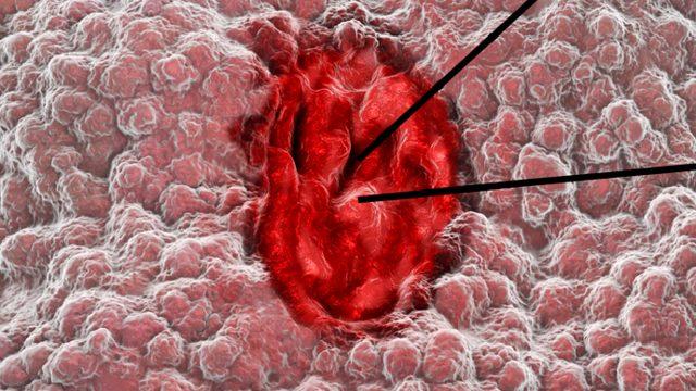 Ülser hastaları nasıl beslenmeli? Ülser olanlar ne yememeli? (Ülser diyeti)