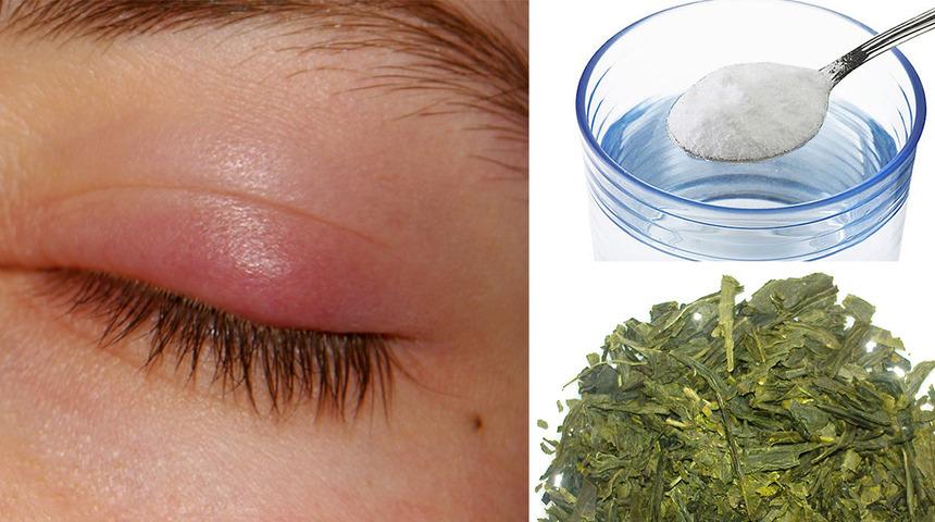 Bu 6 Karışımla Göz Enfeksiyonunu Mutfağınızda Tedavi Edebilirsiniz!