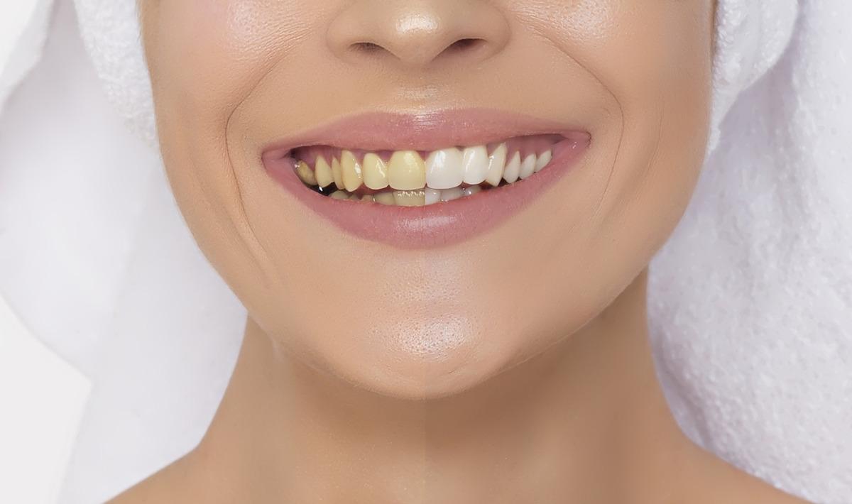 D&uuml;zenli yapıldığında g&ouml;zle g&ouml;r&uuml;len sonu&ccedil; veriyor! İşte dişleri doğal olarak beyazlatmanın yolları