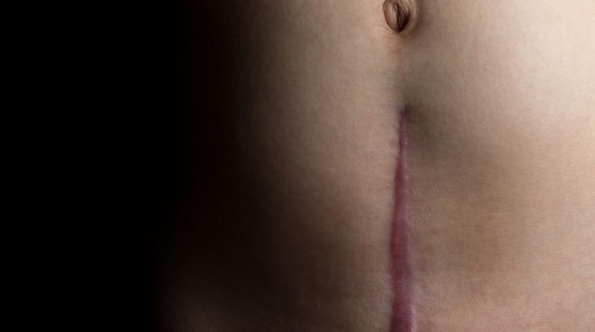 Sezaryen ile yapılan doğum bir sonraki gebelikleri riske atıyor